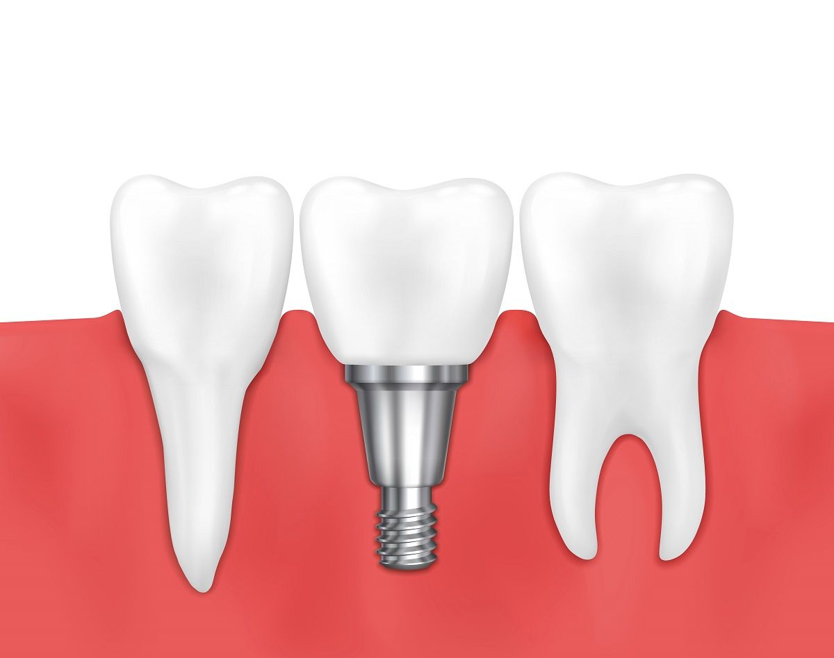 What are Endosteal dental implants?