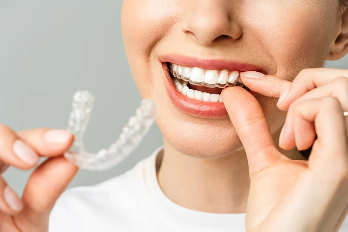 A Perfect Fit: Customization in Invisalign Treatment