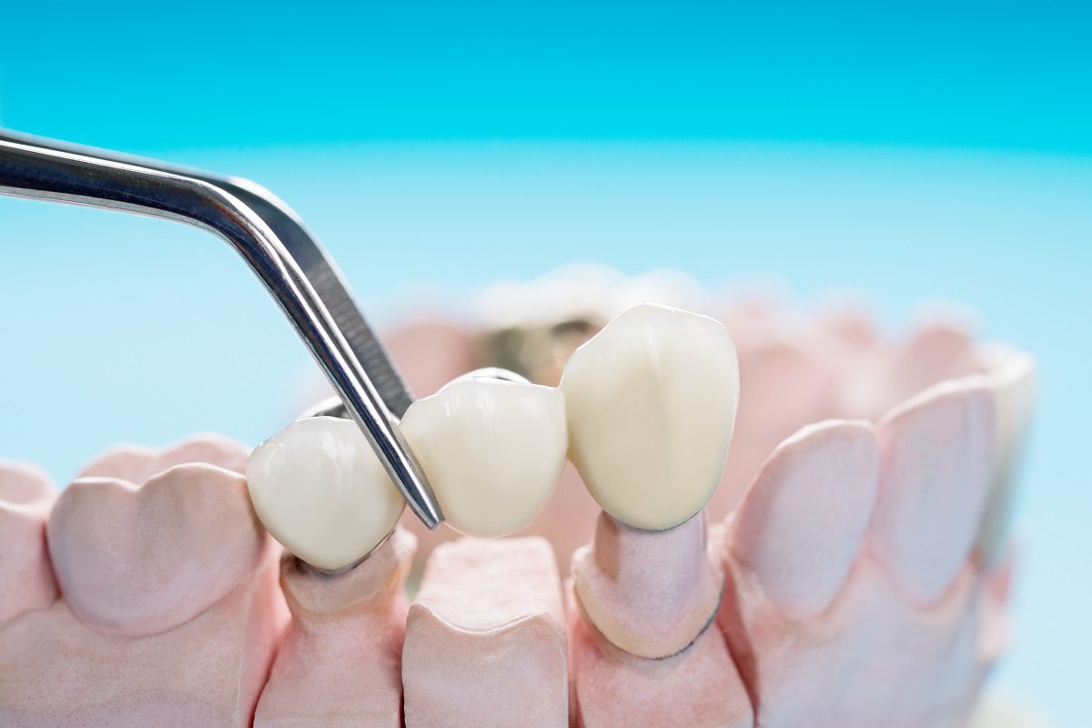 How do dental bridge procedures improve your dental health?
