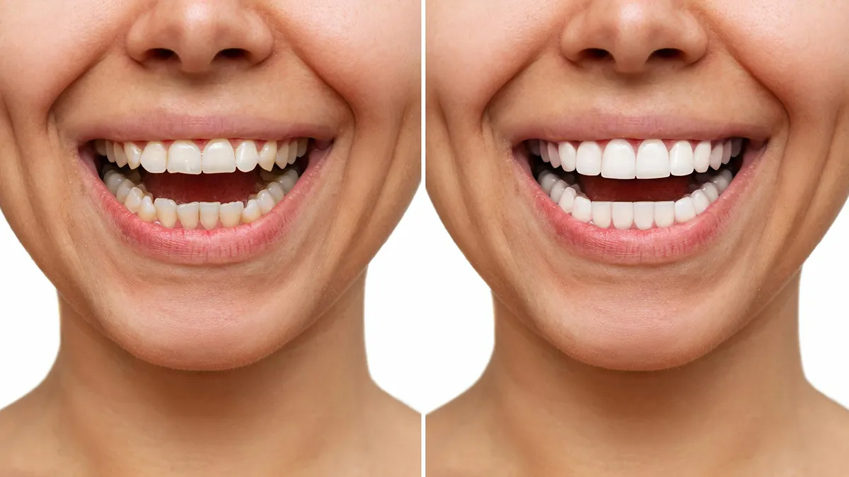 Dental Veneers Before and After: Real-Life Success Stories