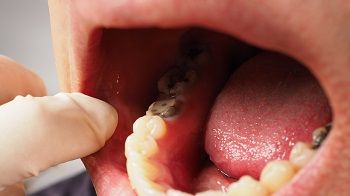 Symptoms root canal infection