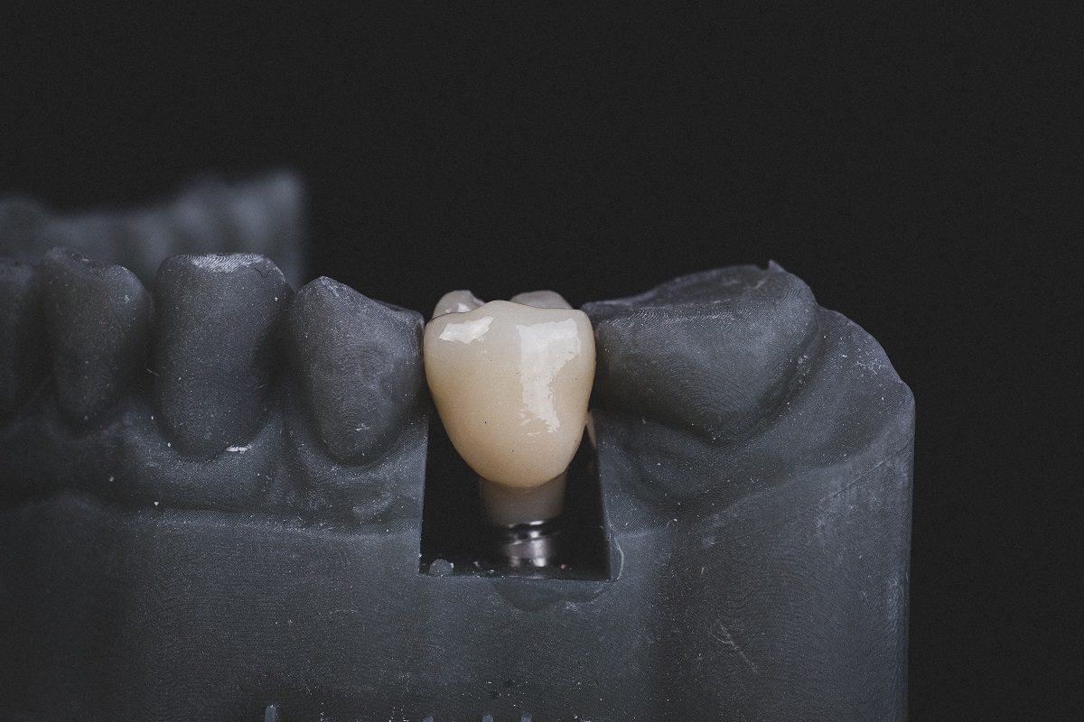 What are the risks and complications related to dental implants?