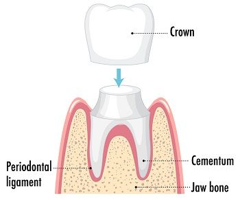 temporary dental crown