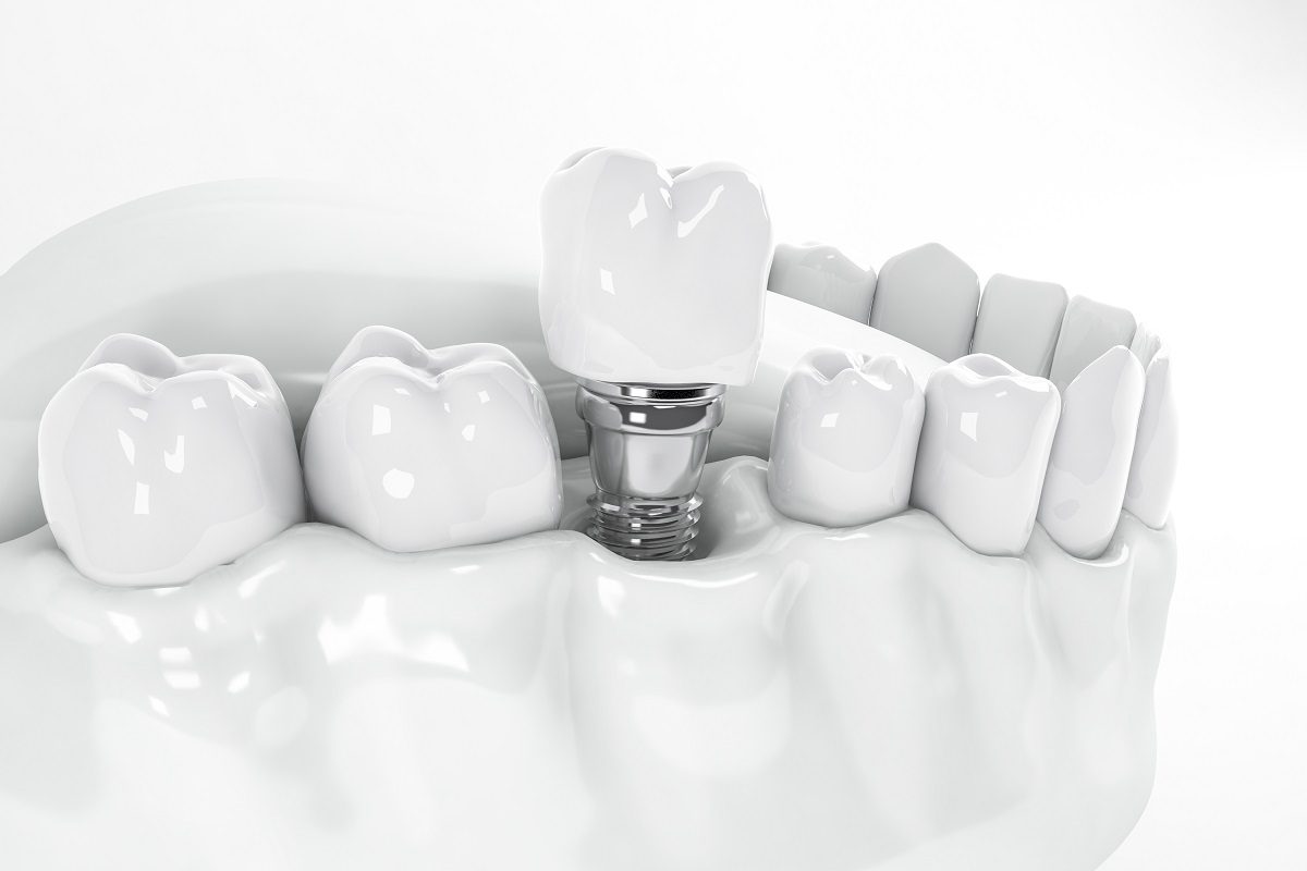 How are All-on-4 Dental Implants Procedure Performed?
