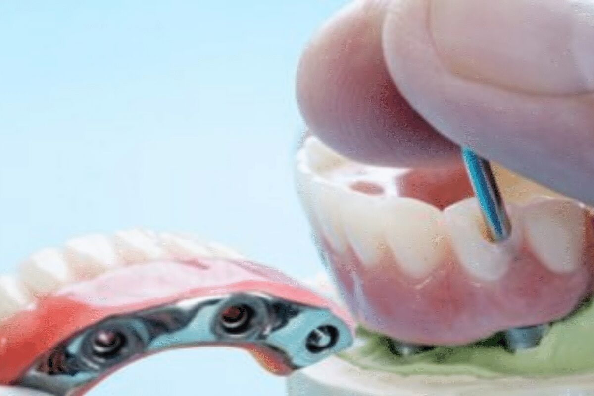 What Are All-On-Four Dental Implants?