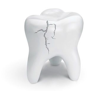 Tooth Fractures and Cracks