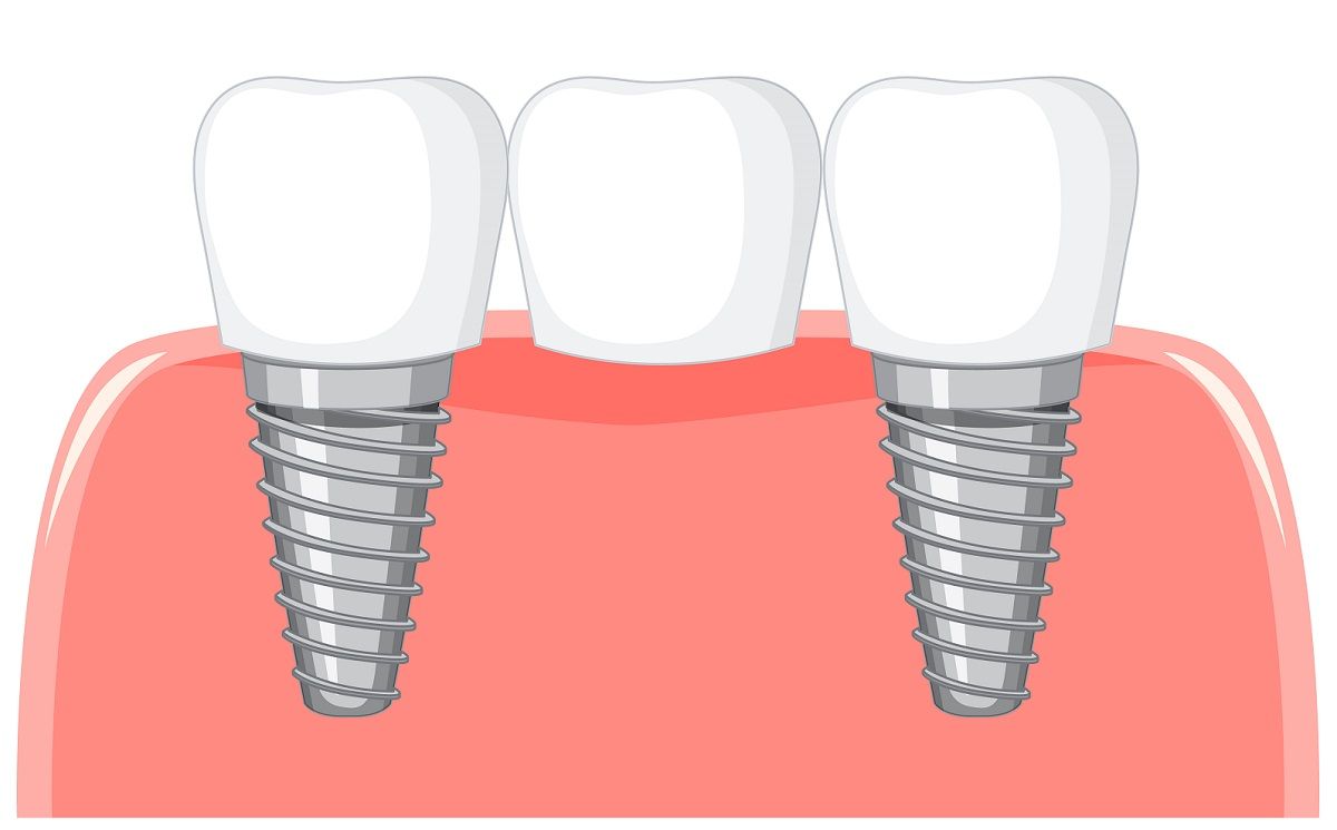 Dental bridge (False teeth): Types, benefits, and cost.