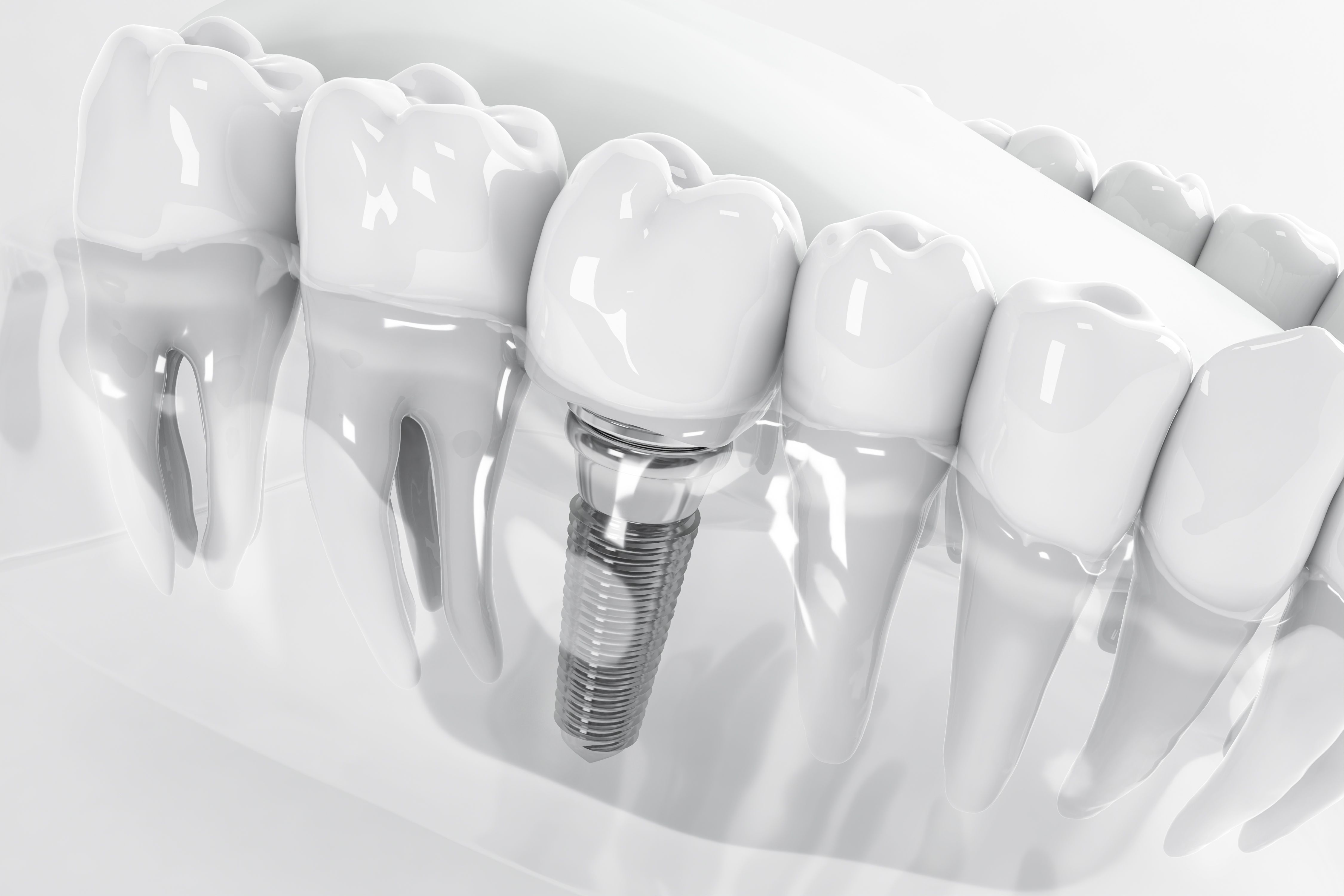 Dental implants for patients with Periodontal Disease.