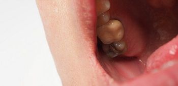 Possible signs of cavities