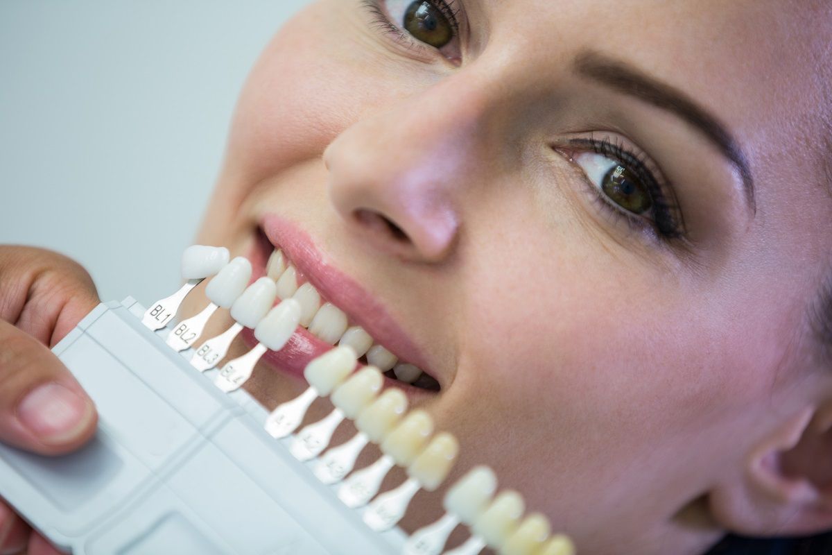 Preparing for Dental Veneers: What You Need to Know