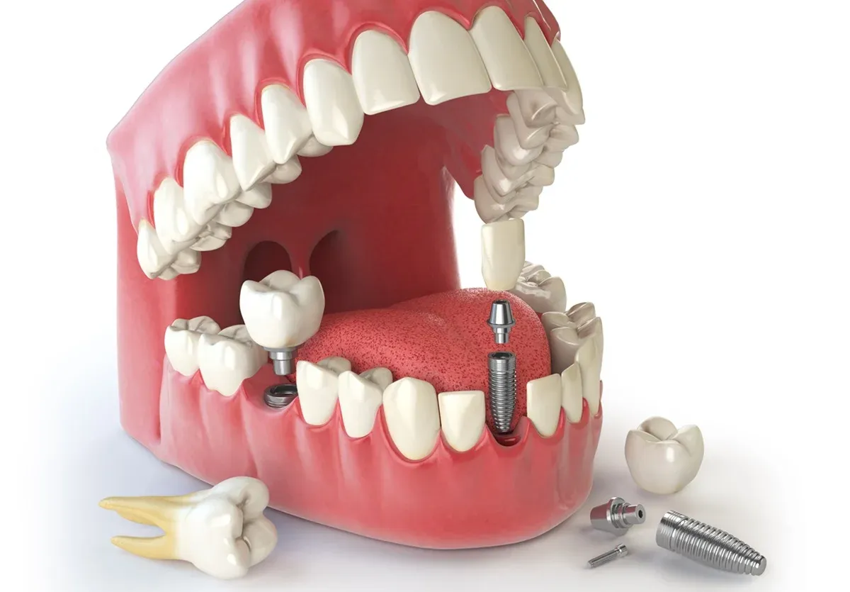 The Main Causes of Tooth Loss and the Need for Dental Implants  