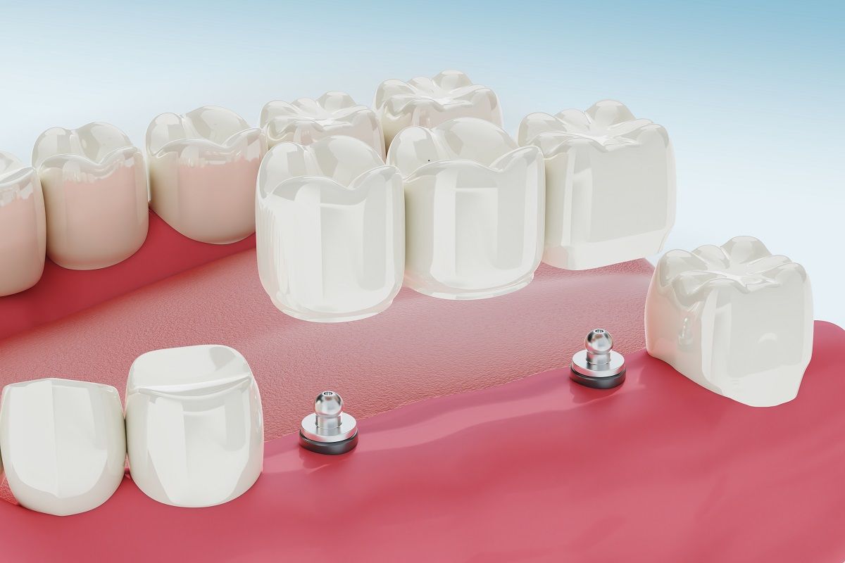 dental-implants-treatment-procedure-medically-accurate-3d-illustration (1).jpg